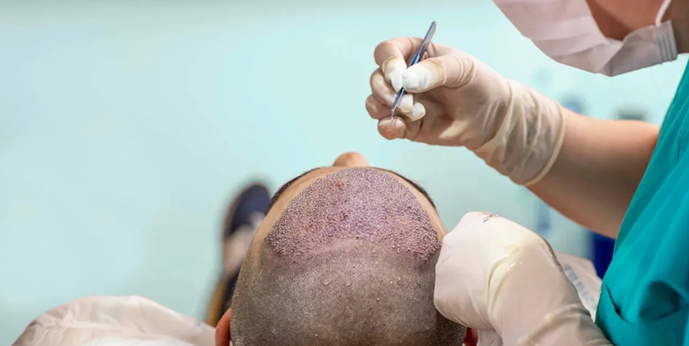 5 Ultimate Places to Visit for Hair Transplant