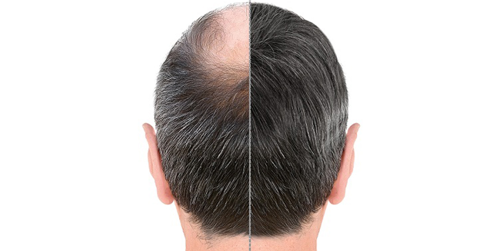   Unraveling the Success of Hair Transplants