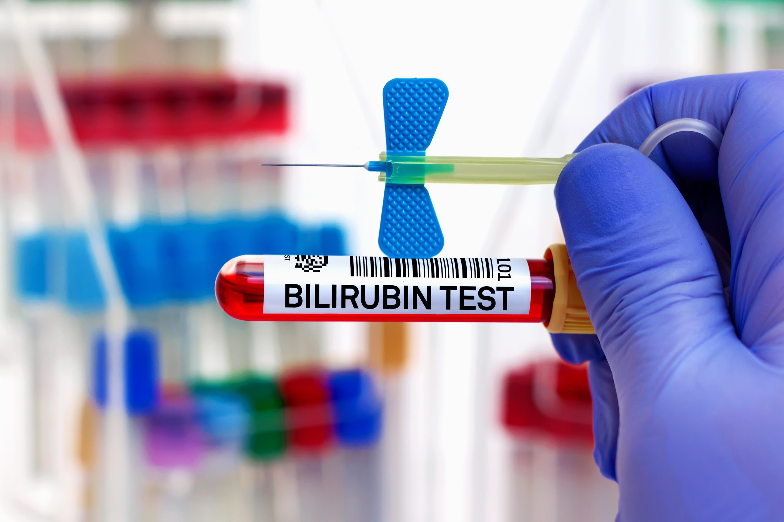 What Is a Dangerous Level of Bilirubin in Adults