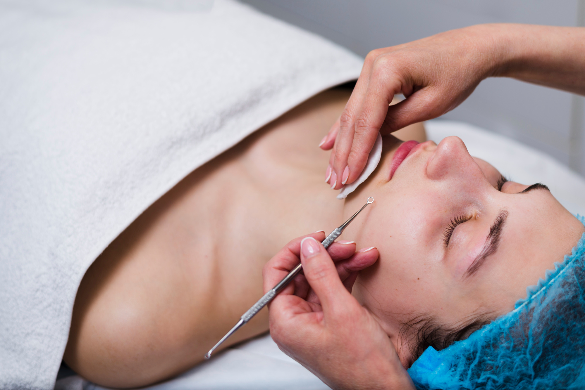 Blackhead Removal