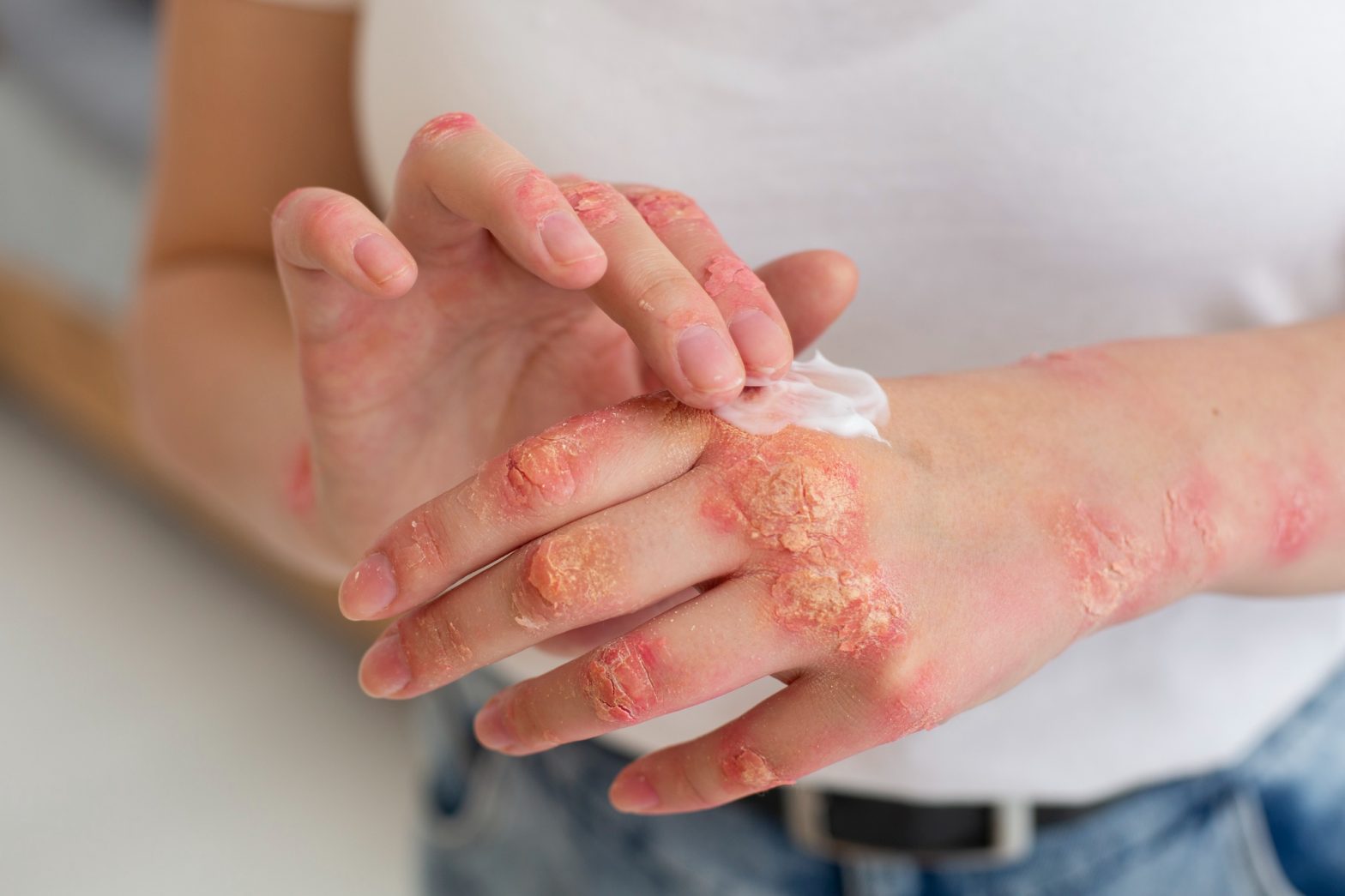 What Are Ayurvedic Treatments for Eczema