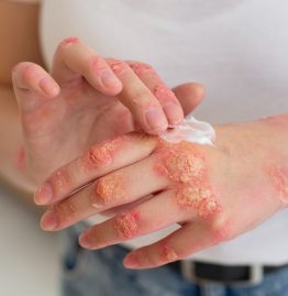 What Are Ayurvedic Treatments for Eczema
